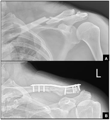 Isolated Middle-Third Clavicle Fracture Causing Horner's Syndrome: A Case Report and Literature Review